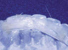 Unidirectional  fibers like Everstick do not adapt well to the contours of the teeth.