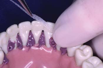 Starting at one end, push the Ribbond fibers through the composite and closely adapt them to the surfaces of the teeth.