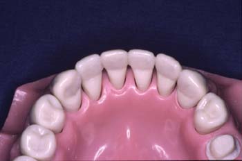 The completed Ribbond Periodontal Splint is thin, aesthetic, and durable.