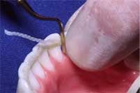 Ribbond Ortho Retainer