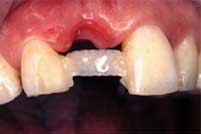 Ribbond Single Visit Bridge